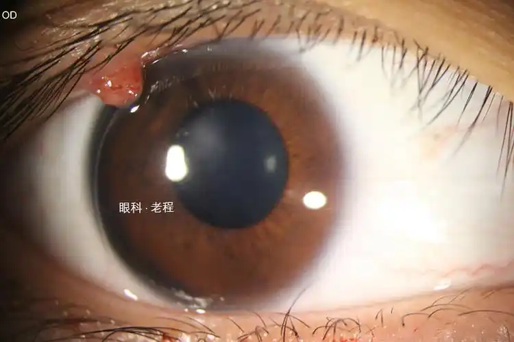 眼皮上长"肉球",是囊肿还是癌症? - 好大夫在线