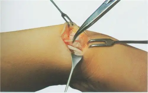 腱鞘囊肿手术后为什么容易复发