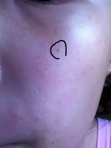 因为用过去黑头的毛孔变大后,挤黑头出血了后面变成一个很大的坑