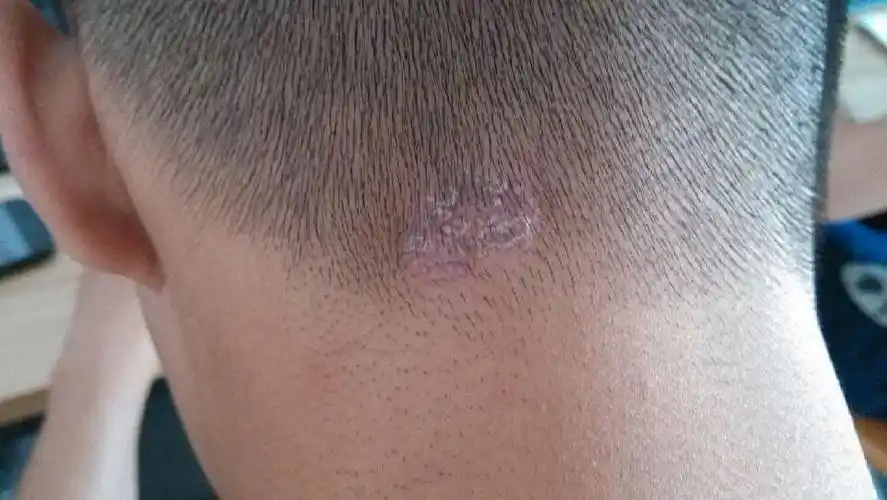 医师来自河北省威县贺营乡卫生院 答: 这个情况一般考虑是头皮癣,这是