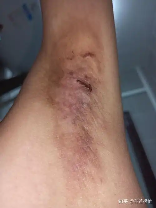 腋下微创手术记录