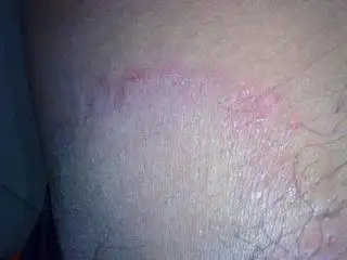 股藓与湿疹图片鉴别