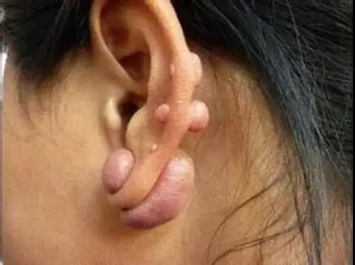可发生于耳廓的任何部位,常有耳部外伤史或穿耳钉史,一般无痛,肿物