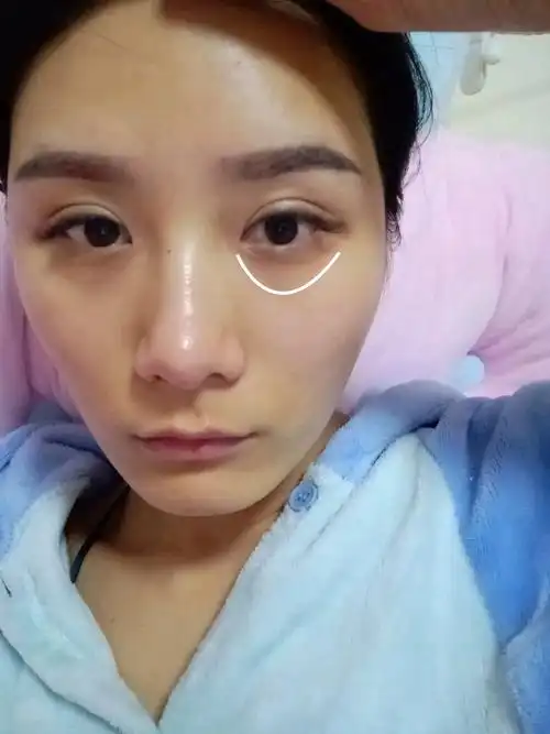 我这个双眼皮适不适合开内外眼睛.再做一次眼部多项