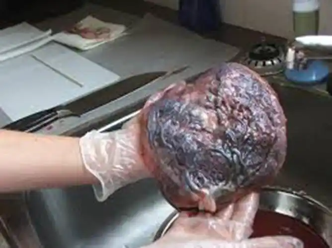 人胎盘详细的特征图片