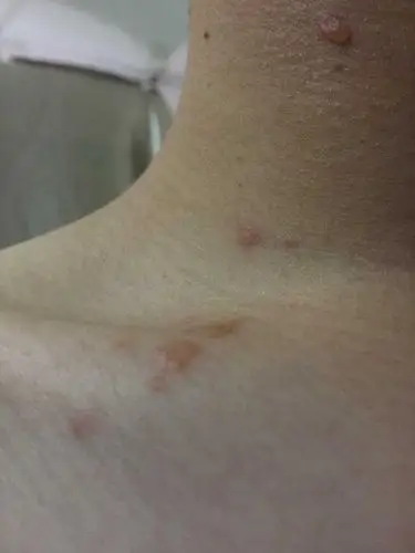 早上醒来发现脖子长了两个水泡火辣辣的中午又长了几个像烫