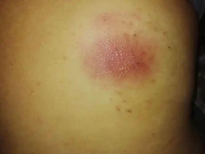 人体的火疖子 (化脓性毛囊及毛囊深部周围组织的感染) 能有多大?