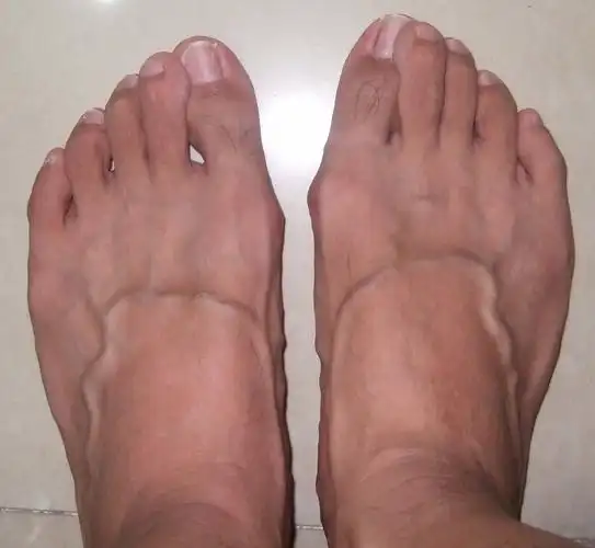 我的脚指头和别人的不大一样,第二个脚趾头压在大脚趾头上的.