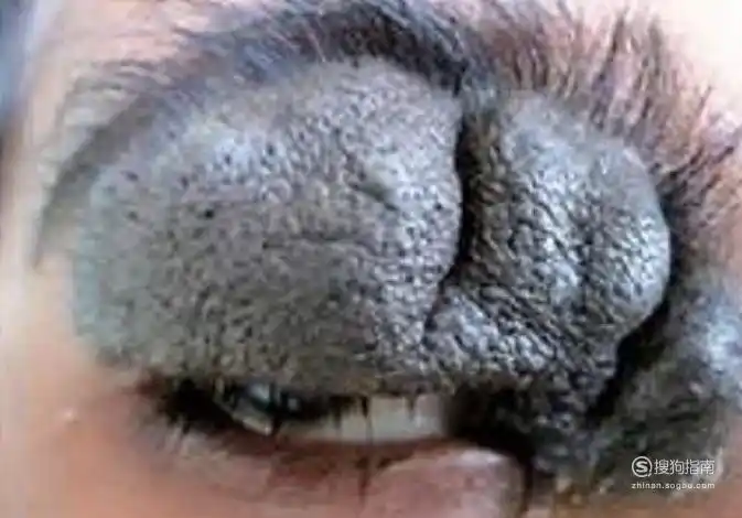 眼皮上长疙瘩怎么办看完就知道