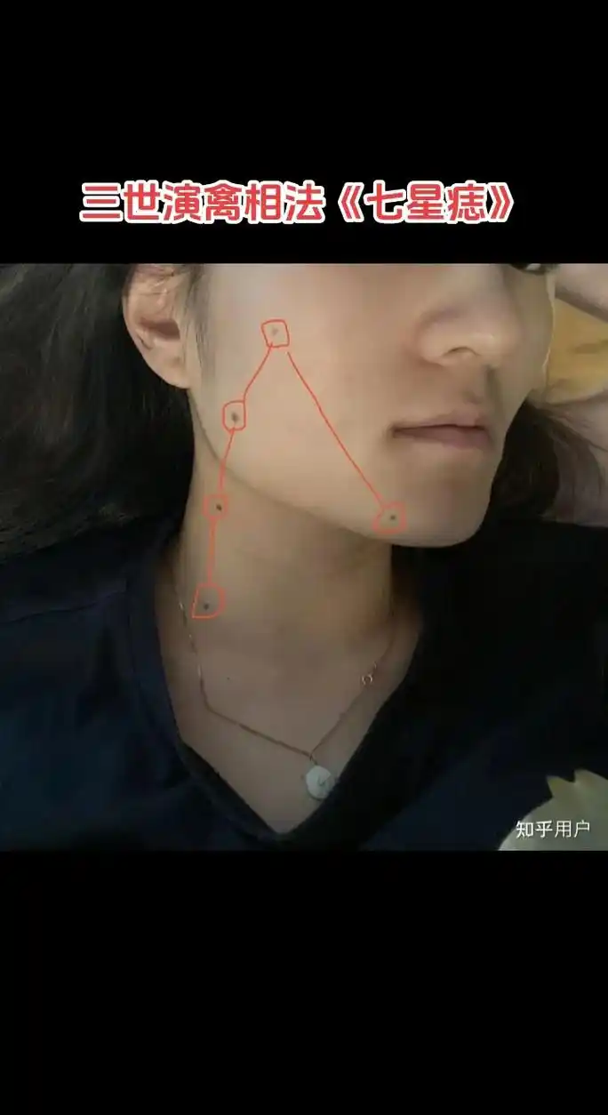 历北斗七星痣痣相不同,寓意不同,那北斗七星痣有什么寓意呢?北 - 抖音