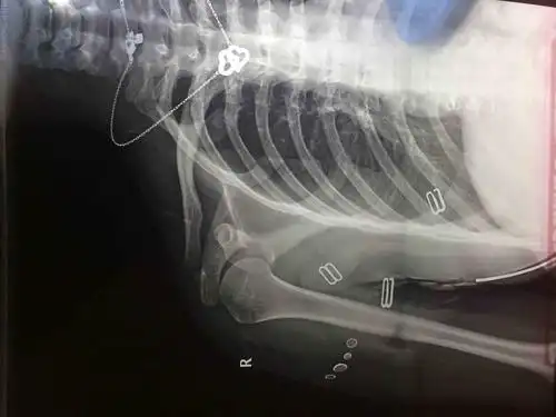 肩关节疼痛,肩关节正侧位平片未见明显异常