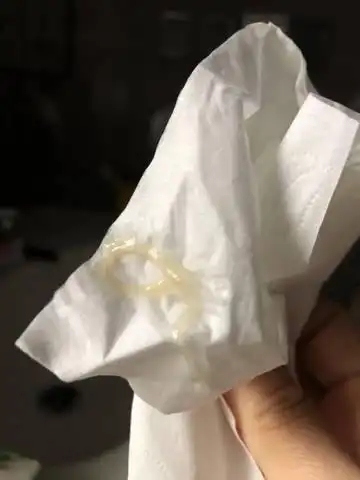 怀孕期 有图慎入: 早上起床,分泌物有点多,请问:里面类似血丝