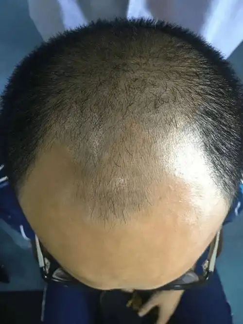 为什么脱发都是头顶中间和前额严重而头的两侧则很少脱发