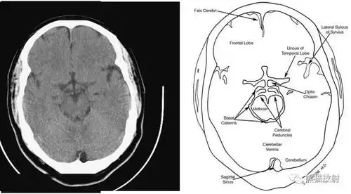 颅脑ct的正常解剖