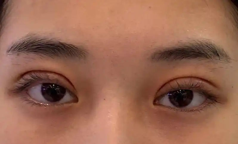 北京割的标准全切扇形双眼皮