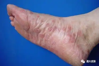 因为它所引起临床症状,往往并不局限于皮肤的常见表现,如下面这些看似