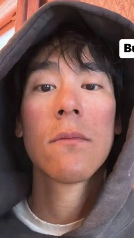 彭于晏脸部晒伤