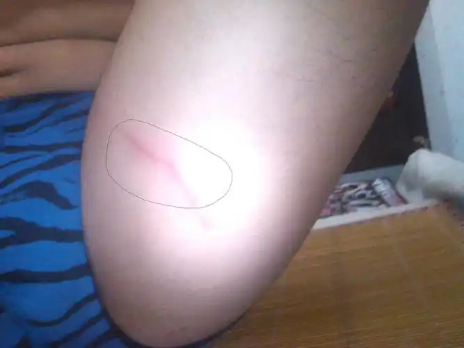 大腿内侧找出一条痕来.痒痒的,一挠就疼,有一点应经有白泡了.怎么办?