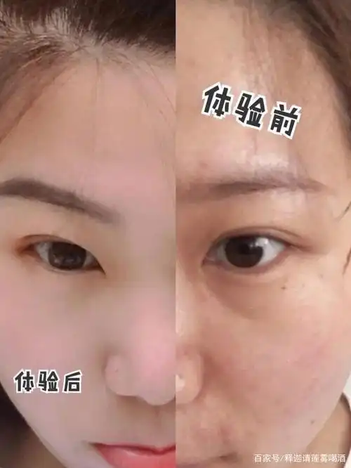 果酸换肤是什么?