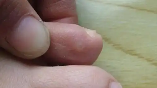 鸡眼初期的症状图片是什么样子 鸡眼形成原因及治疗方法 - 生活百科网