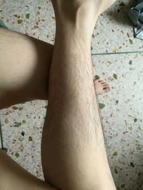 男生腿毛浓密怎么办?