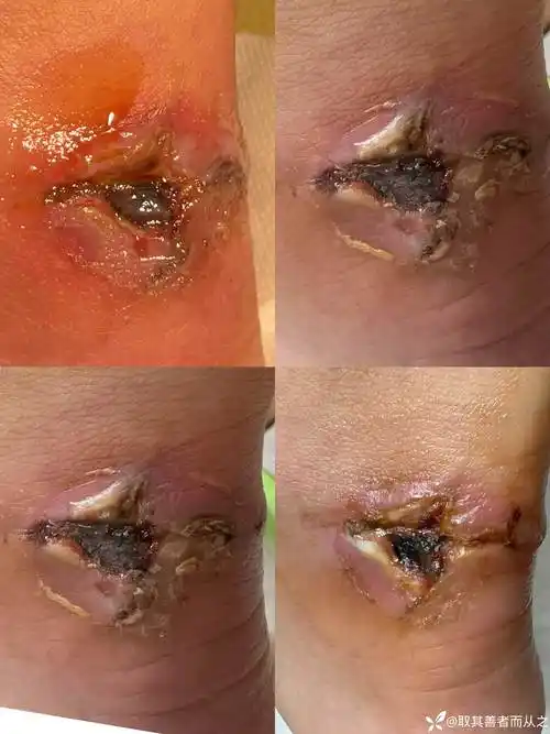 外伤皮肤坏死创面一例