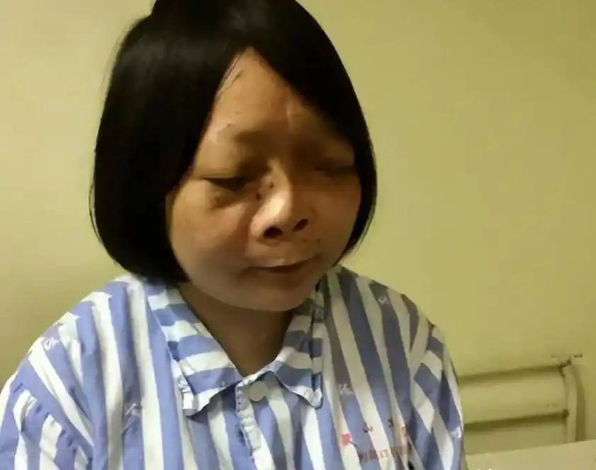 浙江9岁女孩长着一张"马脸",蒙面13年不见人,医生换脸助新生