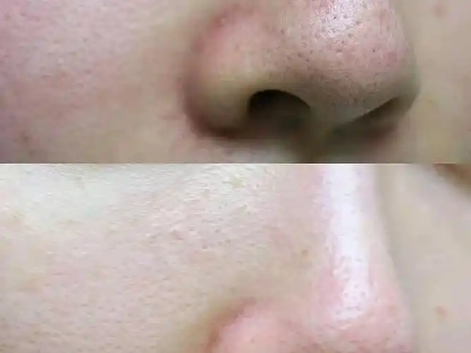 答:不一定 第一:医美收缩毛孔能够持续多久时间呢?