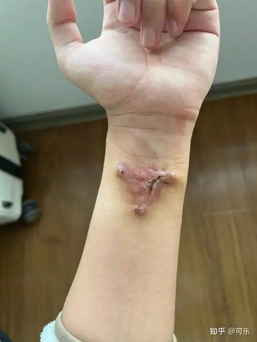 纹身切除手术 - 知乎