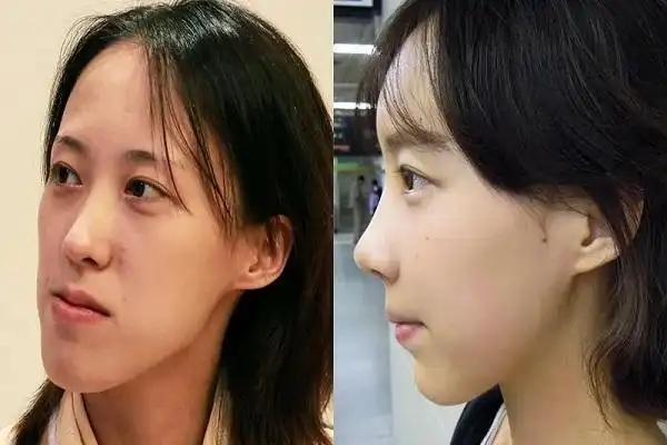 下巴太长怎么自然变短