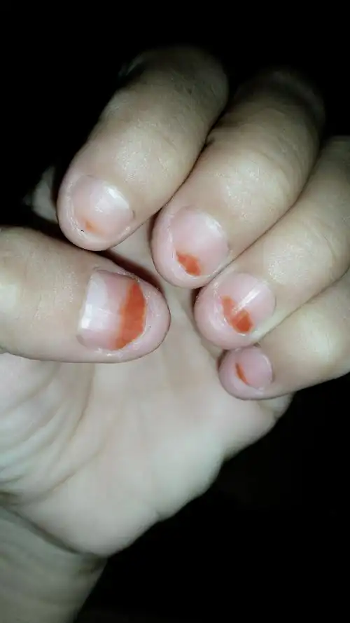 怎么才能改掉咬指甲的不良习惯,真的好郁闷,不由自主的咬指甲,咬的