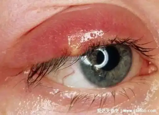 变化的,麦粒肿是会出现红肿的情况的,比如眼睛的肤色是不是和平时不同