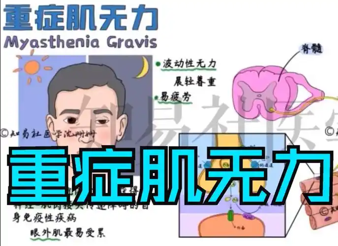 医学带背 【重症肌无力】病因机制 症状 诊治
