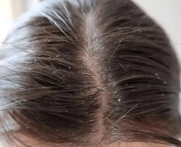 昆明头皮管理:头皮屑产生的原因及生理现象_细胞_表皮_肉眼