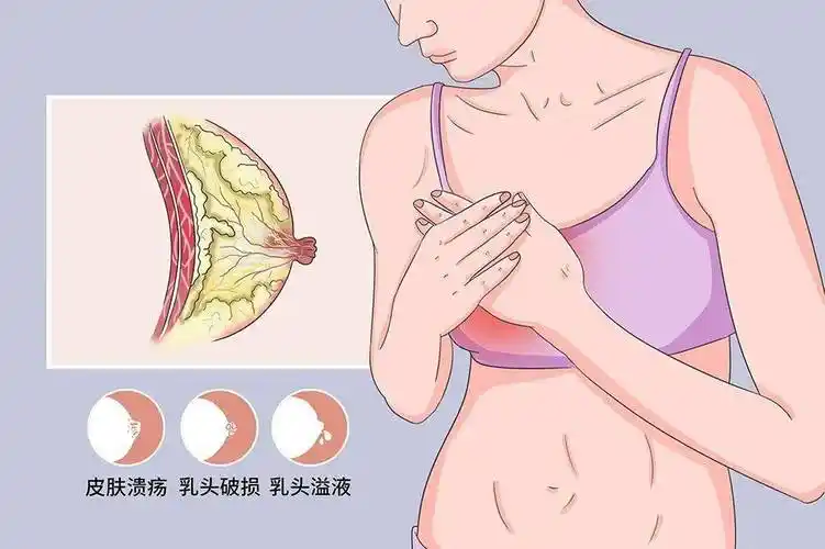 乳腺篇开奶涨奶乳头白点哺乳问题大解析