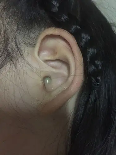 八岁小女孩儿的耳朵,能不能帮忙看看