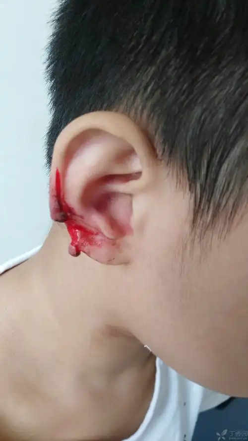 耳廓皮肤部分缺损