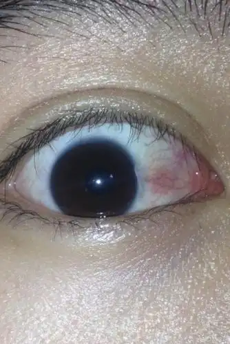 假性翼状胬肉可以手术治疗吗?