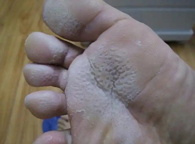 脚底板经常这样,见图,平时穿鞋脚汗大,半天或者稍微热水泡脚五分钟就