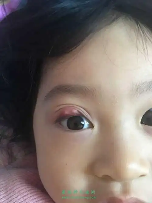 霰粒肿全麻手术值得不值得?