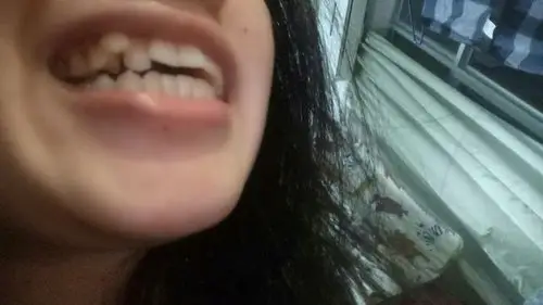 这虎牙能不能拔