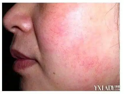 脸上有红血丝怎么清除?民间偏方帮你彻底根治_大全-幸福起航