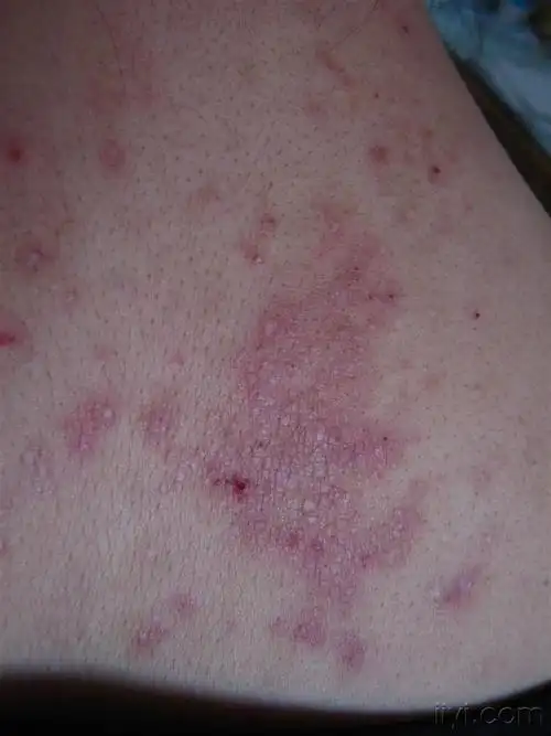 女患者的颈背部---------神经性皮炎 - 皮肤及性传播疾病讨论版