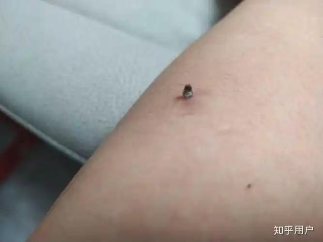 黑头大到直接挤出来是什么感受?