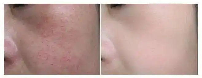 不同肤质皮脂膜受损的应对措施_网易订阅