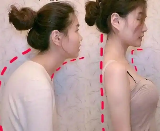 孩子喜欢含胸驼背,不仅影响身体发育,还可能会影响身心健康|驼背|身体