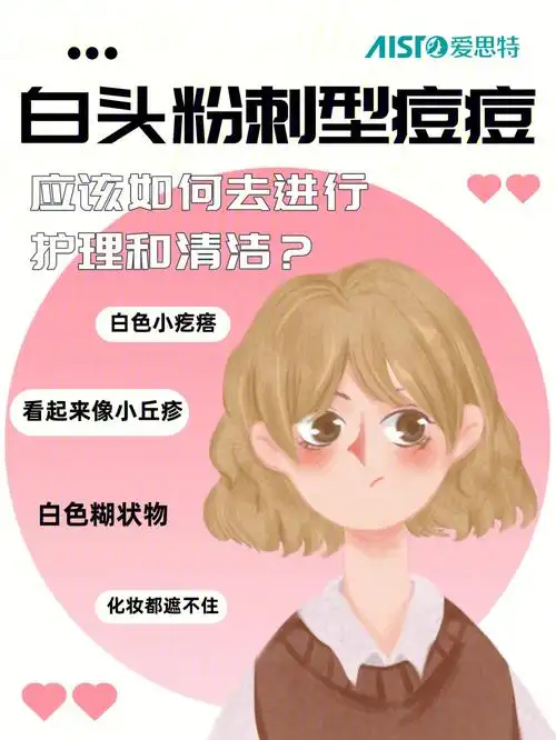 白头粉刺痘痘应该如何处理和清洁