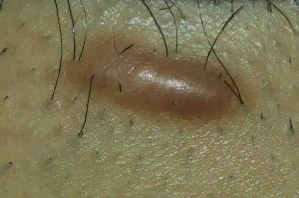 身上长个肉疙瘩硬硬的 偶尔有些痒痛像针刺痛 有没懂得朋友说说看是