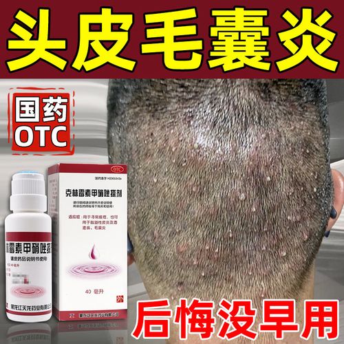治毛囊炎头部专用药 头皮痒脂溢性皮炎头上长疙瘩脓包 后脑勺头皮毛囊