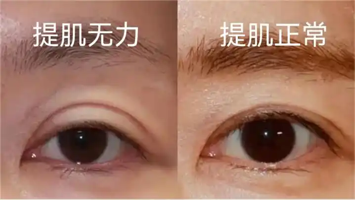 双眼皮提肌不要乱做!医生教你2招判断是不是提肌无力!